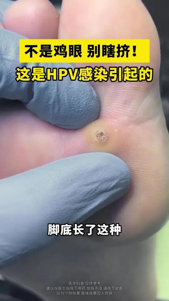 这不是鸡眼,千万别挤!是hpv感染引起的