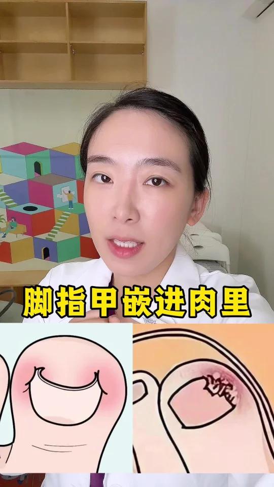 脚指甲长肉里怀疑人生？！一招避免反复发作