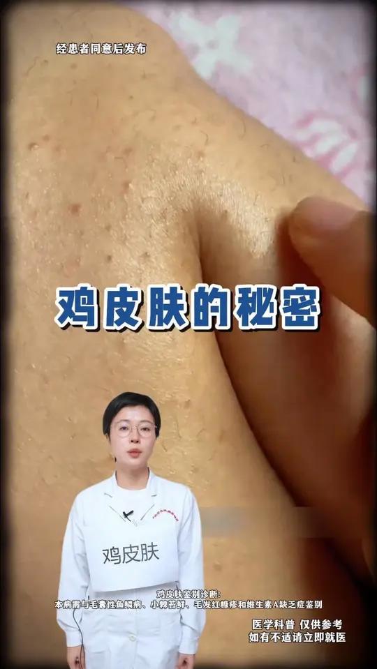 鸡皮肤的秘密 鸡皮肤 毛周角化症
