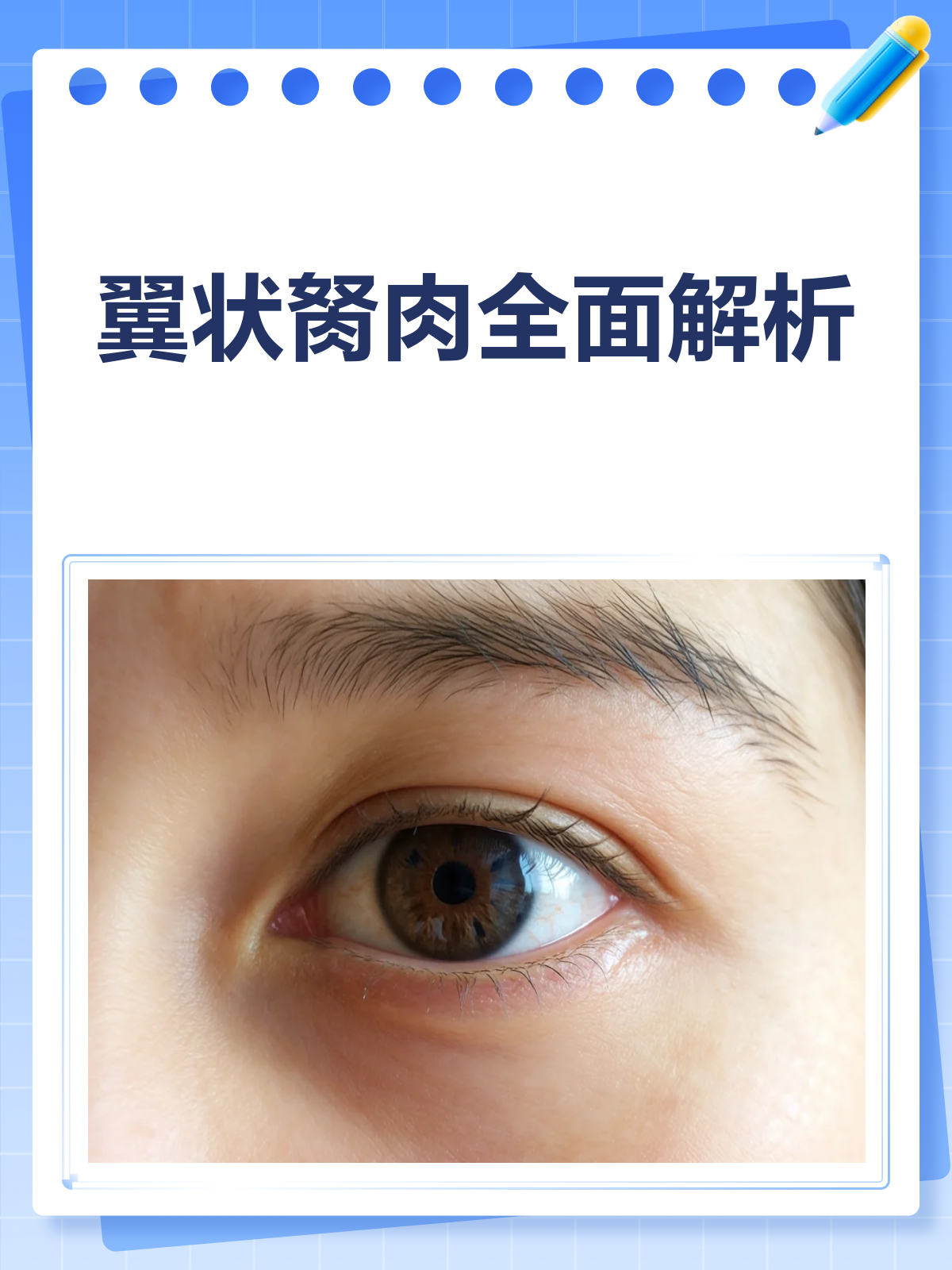 翼状胬肉来袭?了解它,才能战胜它!