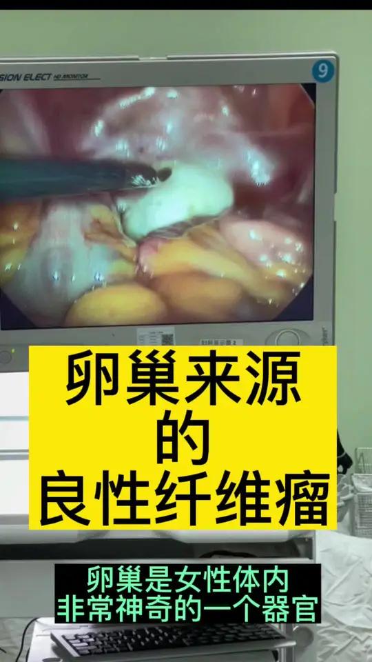 腹腔镜下卵巢纤维瘤切除术。卵巢纤维瘤是卵巢少见的肿瘤,大部分为良性!医学科普囊肿腹腔镜关爱