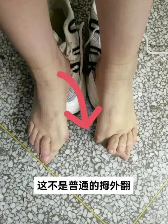类风湿导致足趾变形,治疗不同于普通拇外翻