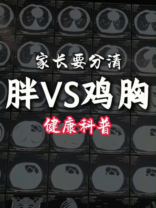 小朋友胖胖的,有时候胸脯也高高的,家长可能会以为是胖的原因,但是一定要先排除鸡胸