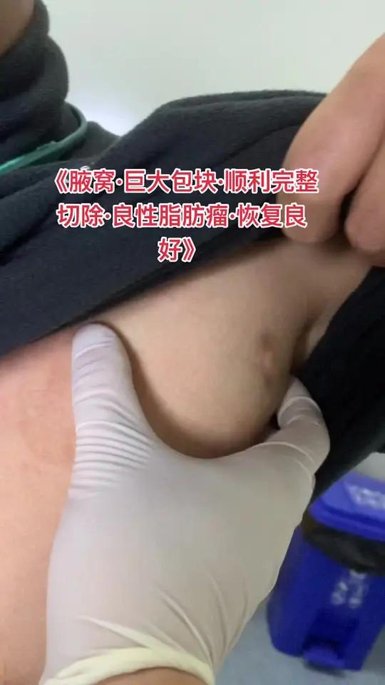 腋窝区域血管神经肌肉丰富,注意包块的准确诊断和完整切除肢体腋窝腋窝包块包块肿物肿瘤良性肿瘤