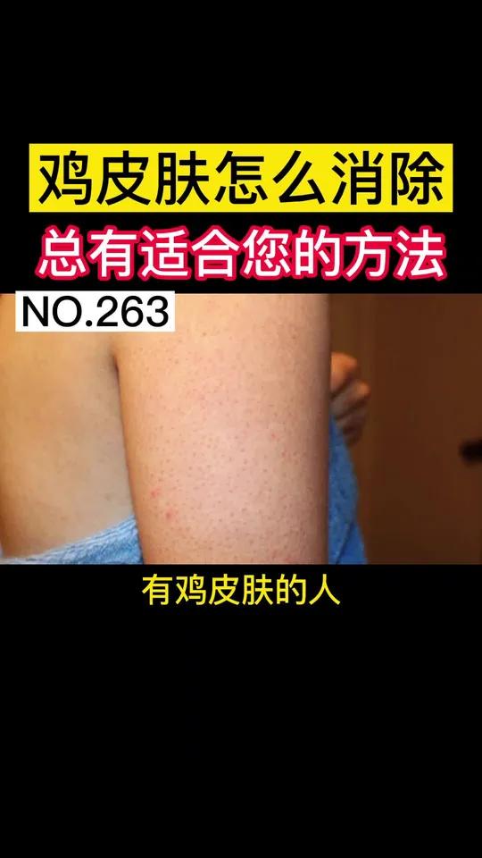 鸡皮肤怎么消除?夏天到了,都不敢穿短裙、短袖了,教你如何改善