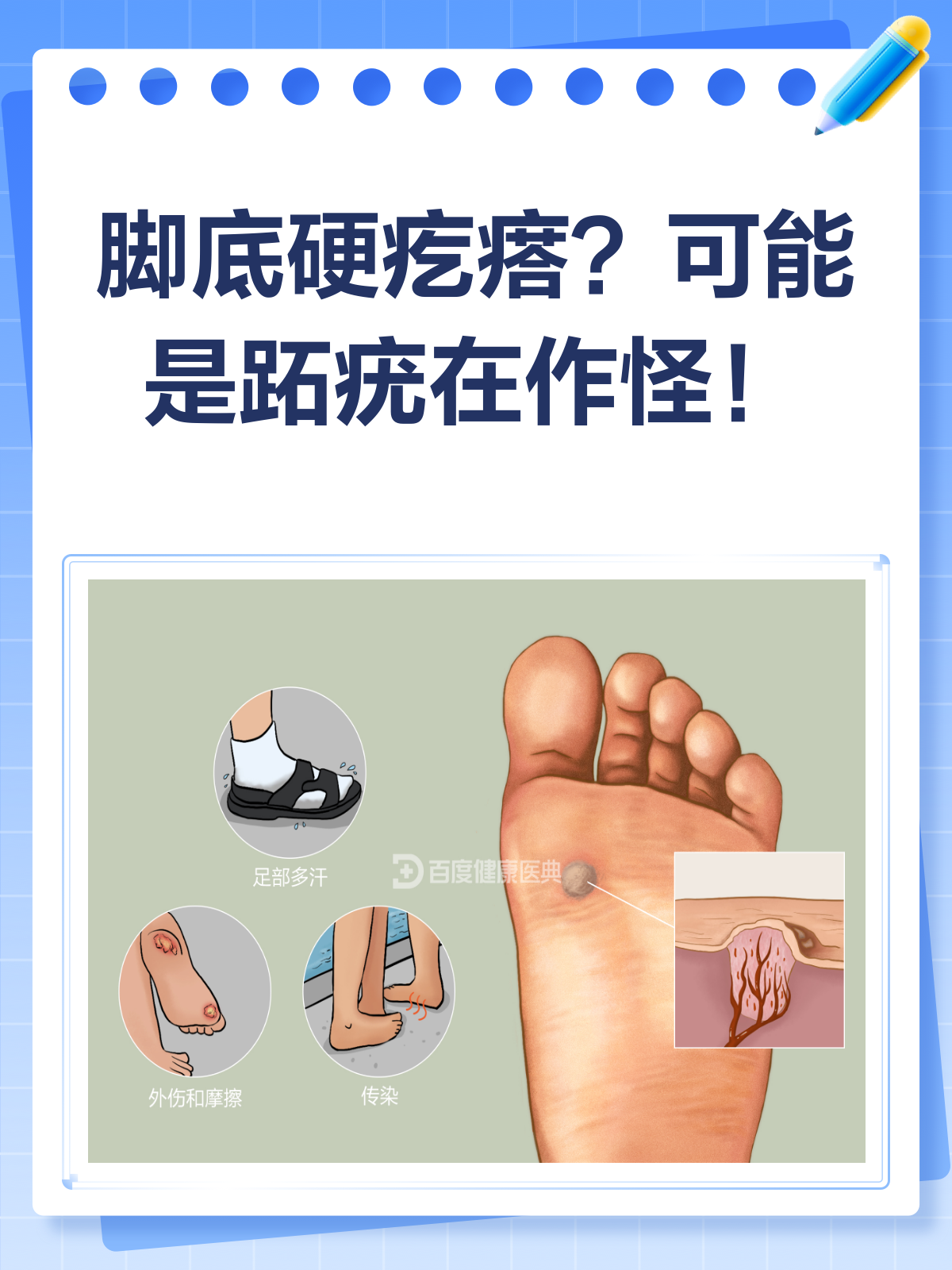 脚底长硬疙瘩?可能是跖疣在作怪!