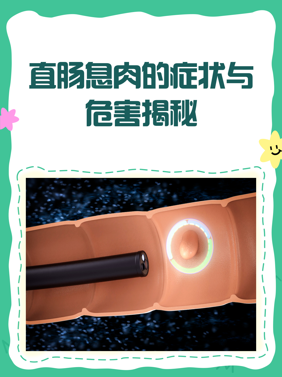 直肠息肉悄无声息?这些症状和危害你得知道!