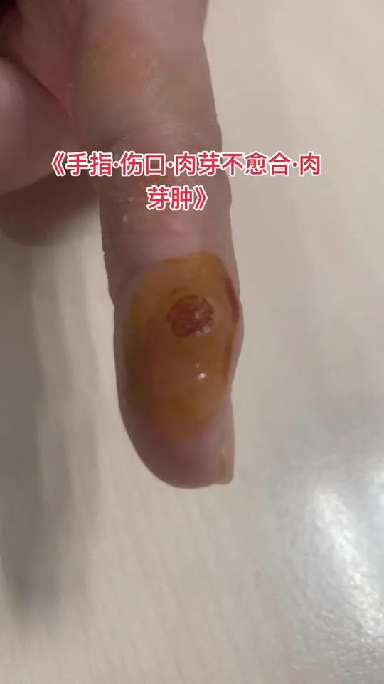 伤口慢性肉芽肿 剪掉或者切除才能愈合皮肤伤口肉芽肉芽肿抵抗力手手指医学科普医学知识炎症感染