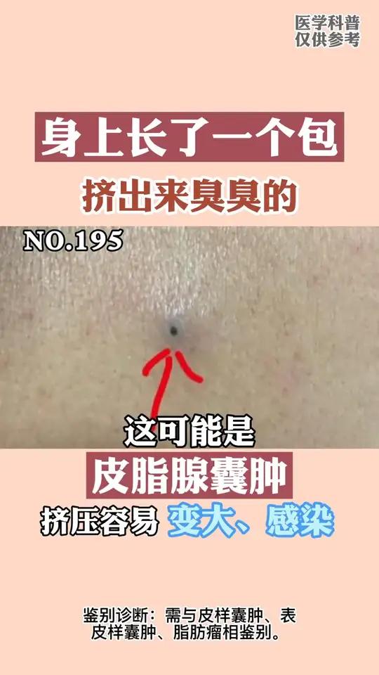 身上一个鼓鼓的包,挤出来还有点臭,这可能是皮脂腺囊肿