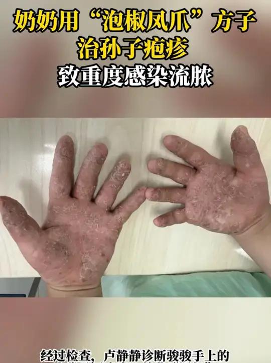 奶奶用“泡椒凤爪”方子治孙子疱疹 致重度感染流脓 泡椒凤爪疱疹 偏方   奶奶用偏方治孙子