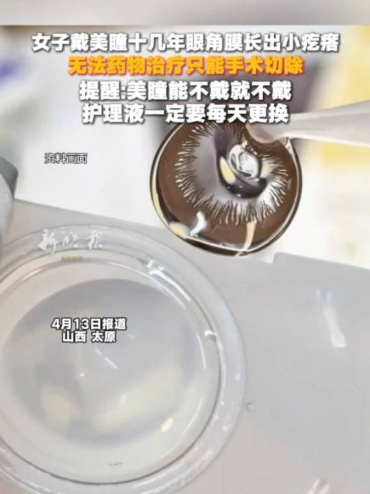 女子戴美瞳十几年眼角膜长出小疙瘩,无法药物治疗只能手术切除。提醒:美瞳能不戴就不戴,护理液