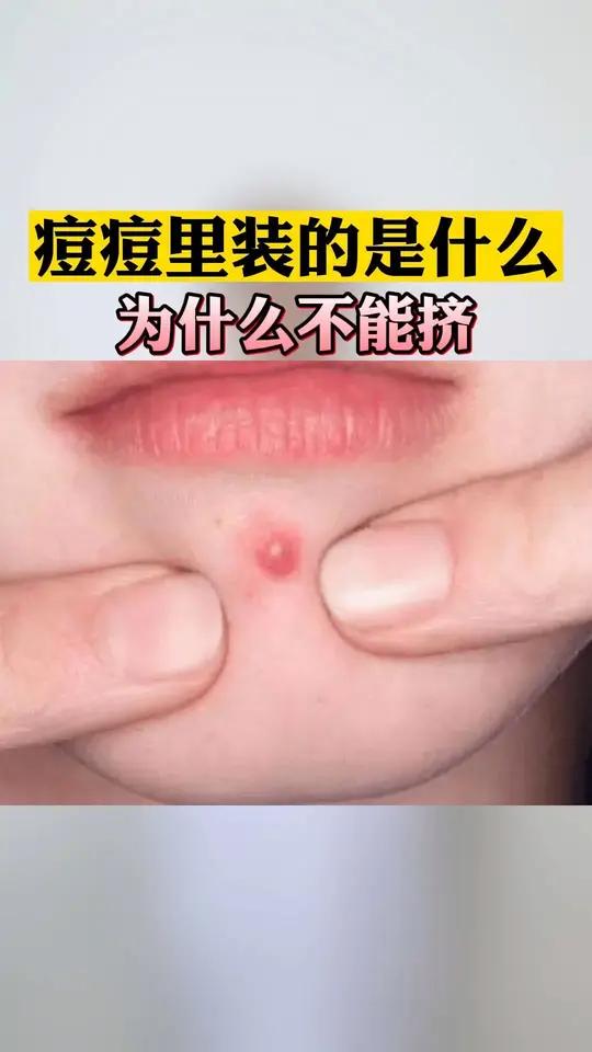 痘痘里的白色物质是什么?为什么不能挤?皮肤科医生告诉你