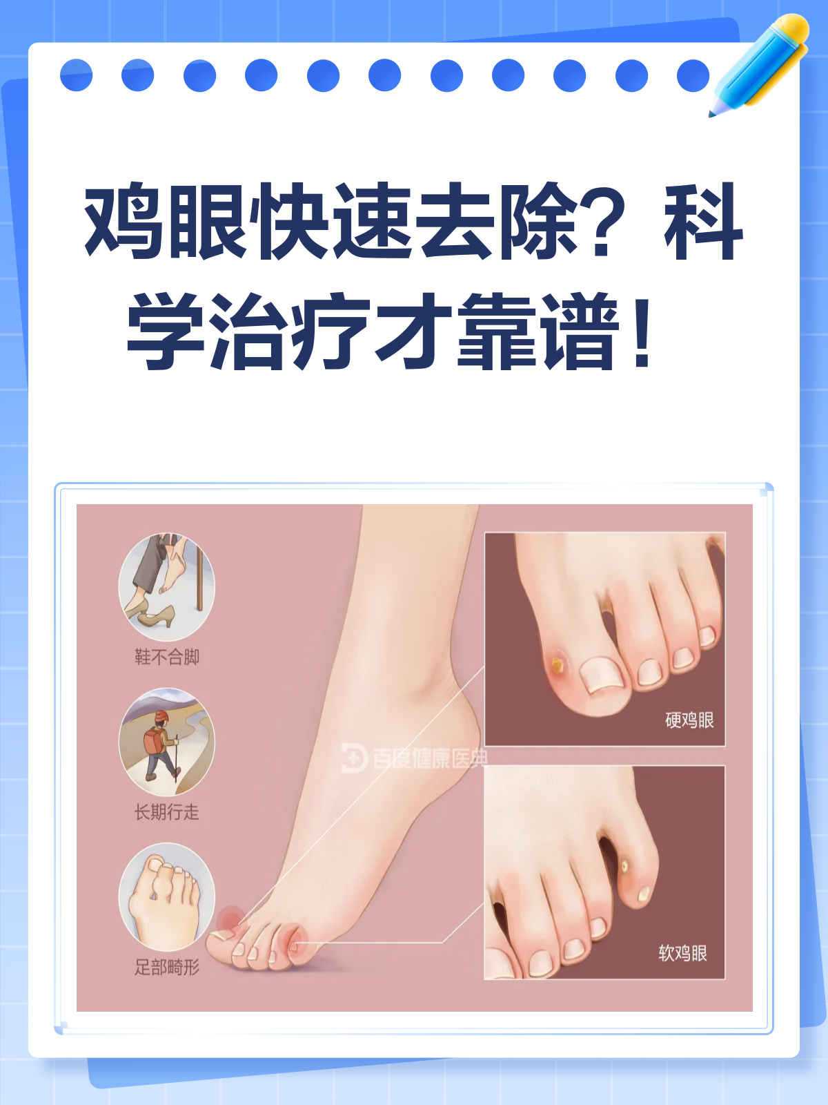 鸡眼去除别信偏方！科学治疗才是王道