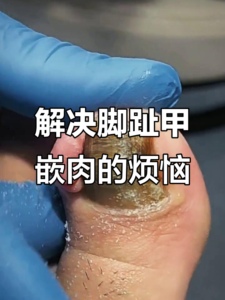 脚指甲长肉里怎么办?修脚大师教你轻松解决
