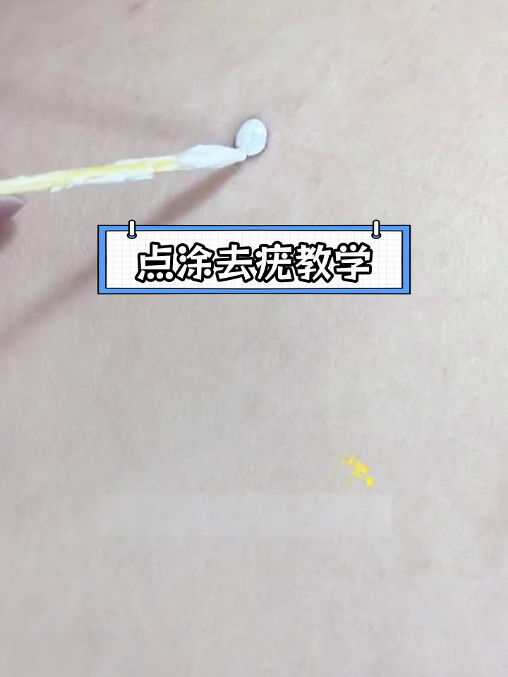 去除肉痣的小技巧,轻松点涂教程