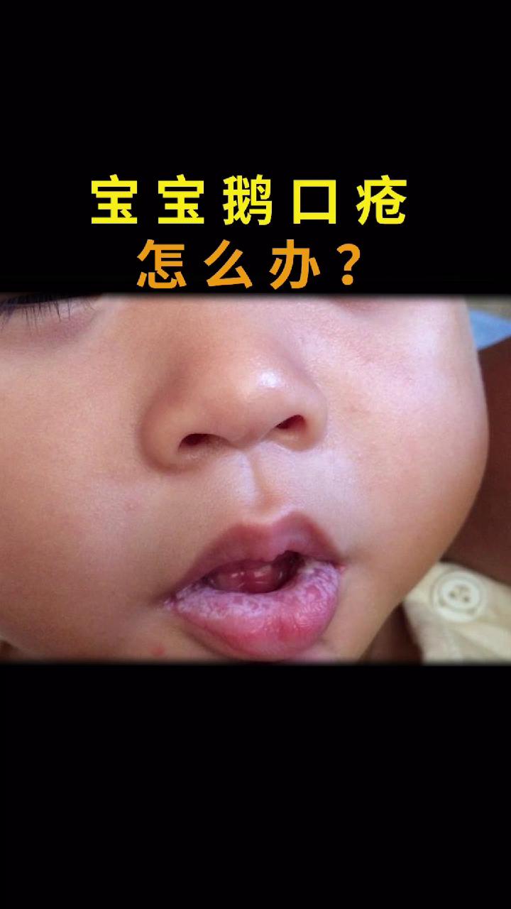 宝宝有白色分泌物且长鹅口疮，究竟该怎么办？