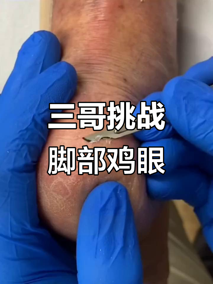 脚上鸡眼长不停,三哥这次能搞定吗?
