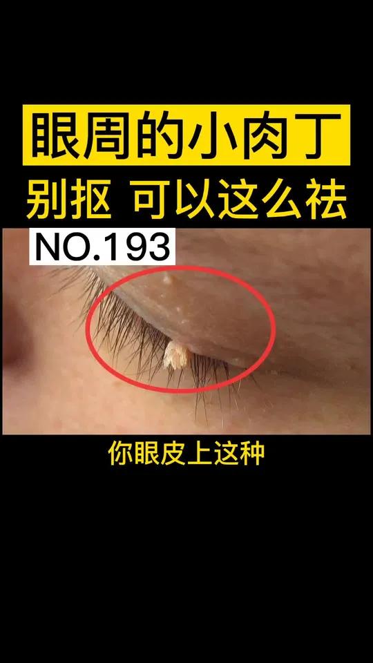 眼周小肉丁很难看怎么去除?别扣抠!
