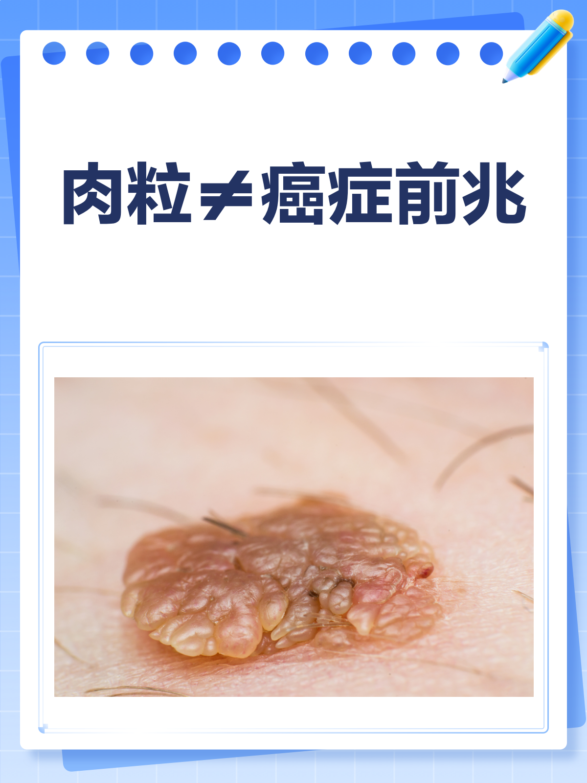 肉粒≠癌症前兆!别慌,先看这篇科普