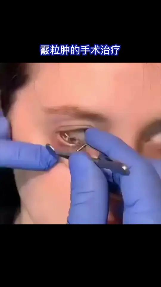 是因睑板腺排出管道阻塞和分泌物潴留的基础上而形成的睑板腺慢性炎性肉芽肿。又称睑板腺囊肿。小