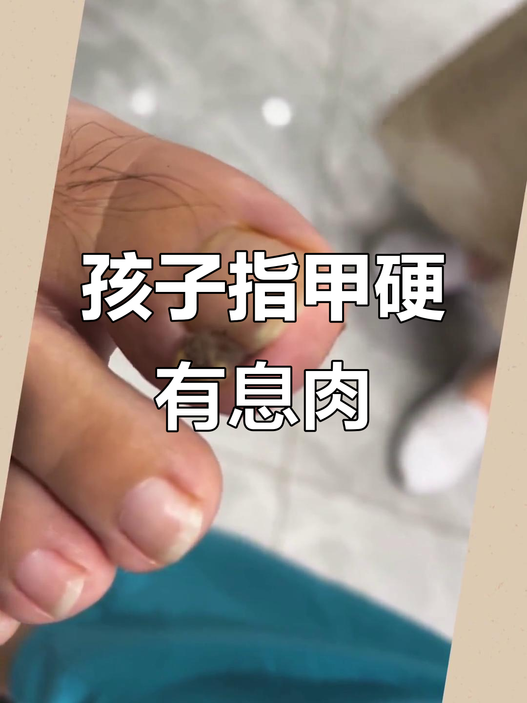 辽阳来的孩子，指甲硬又长息肉，消毒工作得做足