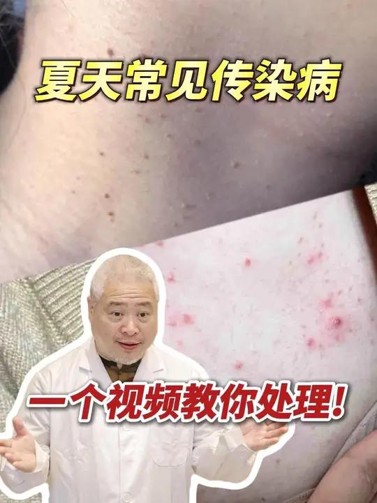 小心!后背长红疙瘩,眼睛长小肉条,都可能是传染病!