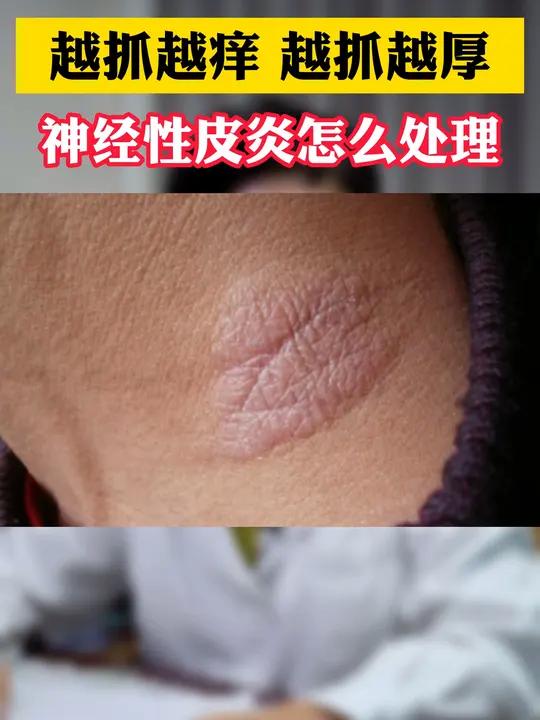 脖子、眼睑长红色斑块,痒的忍不住去抓,这是