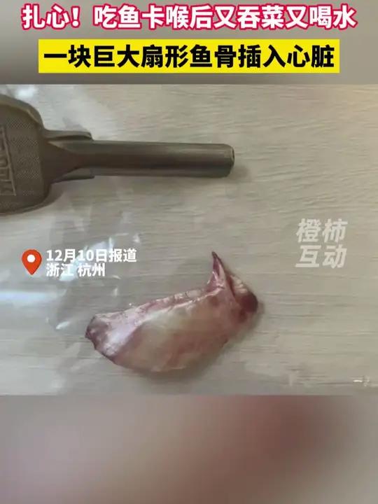 这次真的扎心了,男子吃鱼卡喉后又吞菜又喝水,一块巨大扇形鱼骨插入心脏