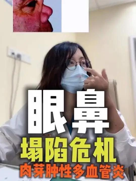 眼鼻塌陷、肺肾受累：肉芽肿性多血管炎 眼鼻塌陷、肺肾受累：肉芽肿性多血管炎 