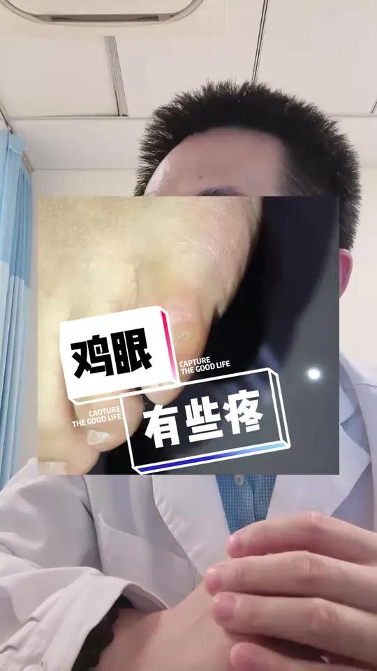 脚上长鸡眼,有些疼,怎么办