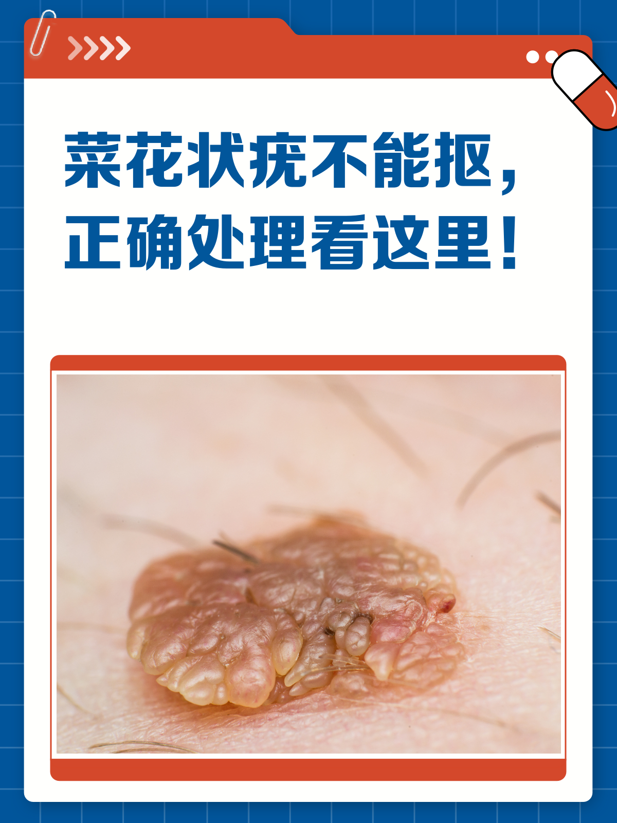 菜花状疣自己抠掉？别大意，处理需谨慎！
