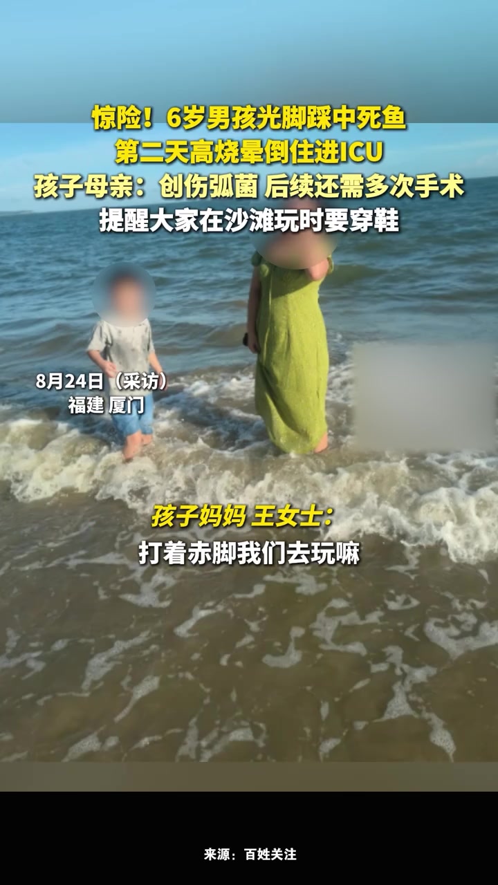 男孩光脚踩中死鱼,第二天住进ICU,孩子母亲:沙滩玩时要穿鞋