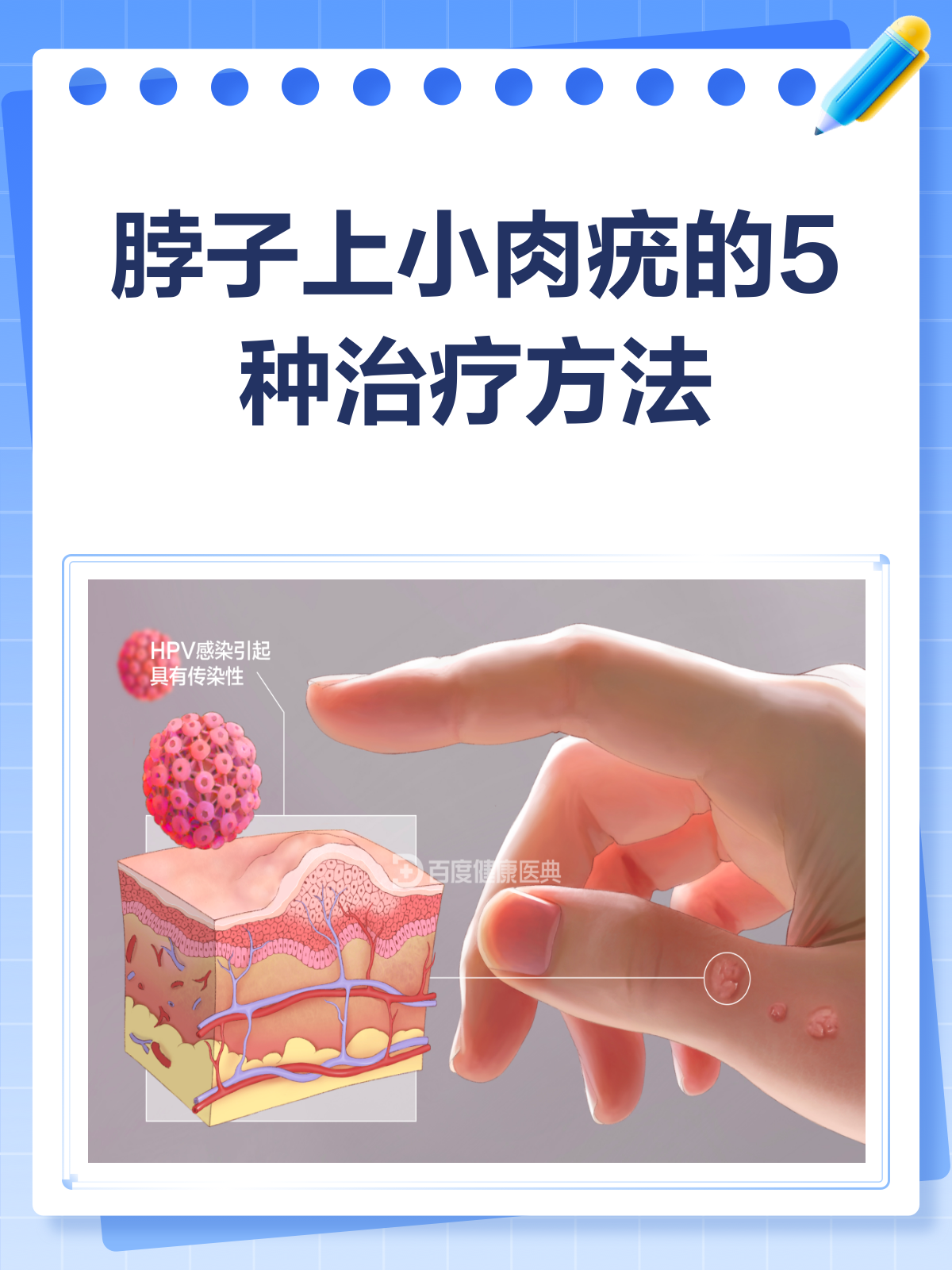 脖子上的小肉疣?别急,教你几招轻松应对!