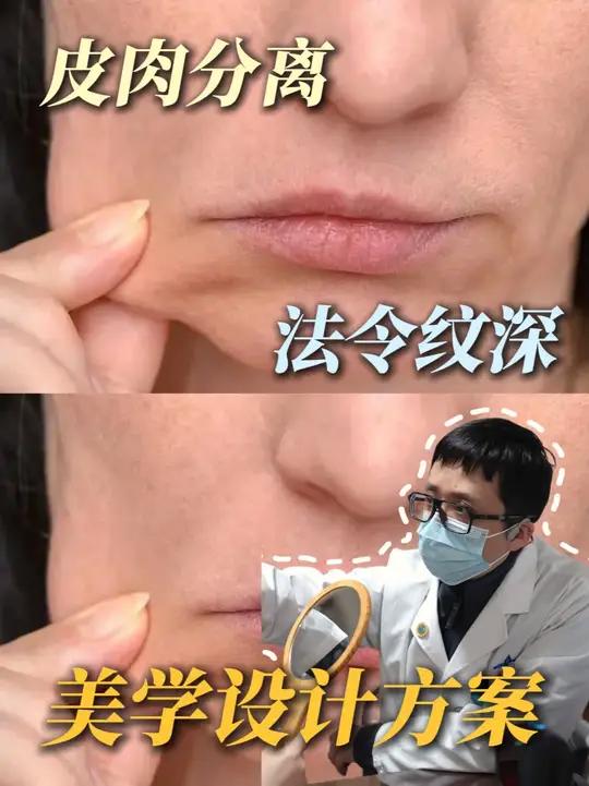 皮肉分离,苹果肌下移,法令纹不贴合如何改善