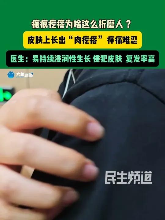 瘢痕疙瘩为啥这么折磨人?皮肤上长出“肉疙瘩” 痒痛难忍 医生:易持续浸润性生长,侵犯皮肤,