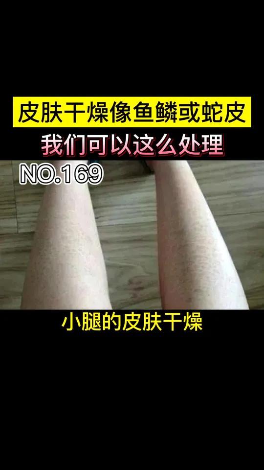 皮肤干燥像鱼鳞或蛇皮,鱼鳞病可以这么办