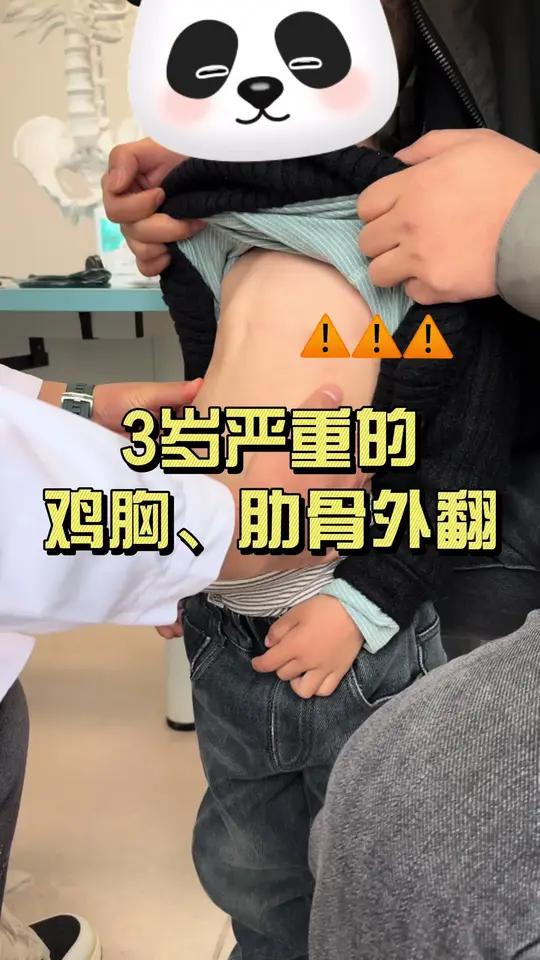 3岁严重的鸡胸肋骨外翻孩子