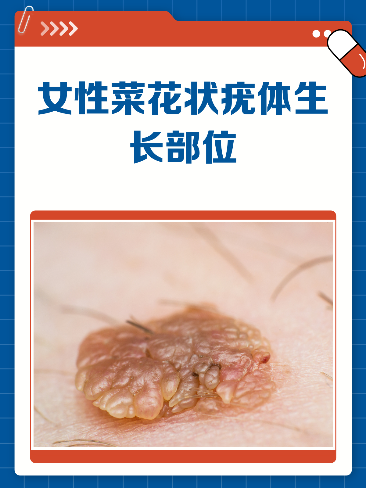 女性菜花状疣，这些私密部位要警惕！