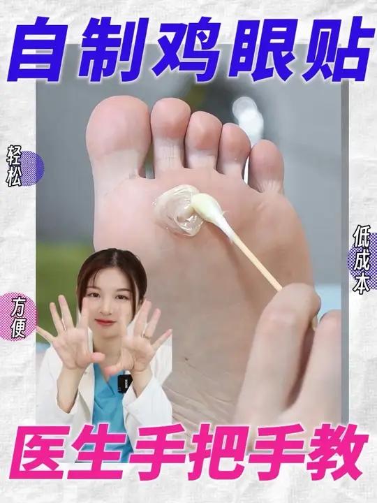 脚底板上长的鸡眼不要再用刀去挖了！皮肤科医生教你自制字眼贴，省钱又高效！