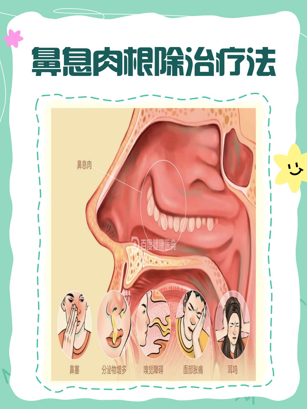 鼻息肉治疗全攻略,怎样才能不复发?