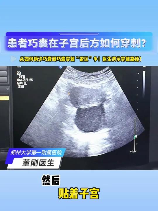 《巧囊特殊位置穿刺难题：董刚医生分享应对策略》