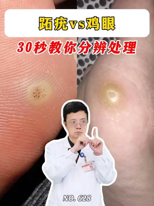 跖疣VS鸡眼，医生30s教你分辨处理！