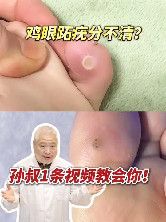 孙叔教你肉眼区分鸡眼和跖疣,千万别搞错了!#鸡眼 #跖疣 #hpv #抖出健康知识宝藏 #