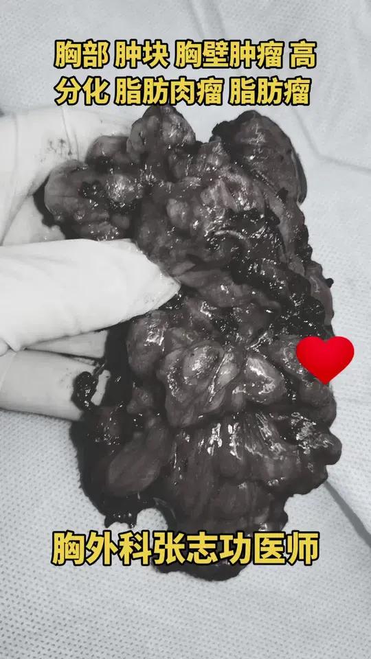 胸部 肿块胸壁高分化脂肪肉瘤脂肪瘤啥样