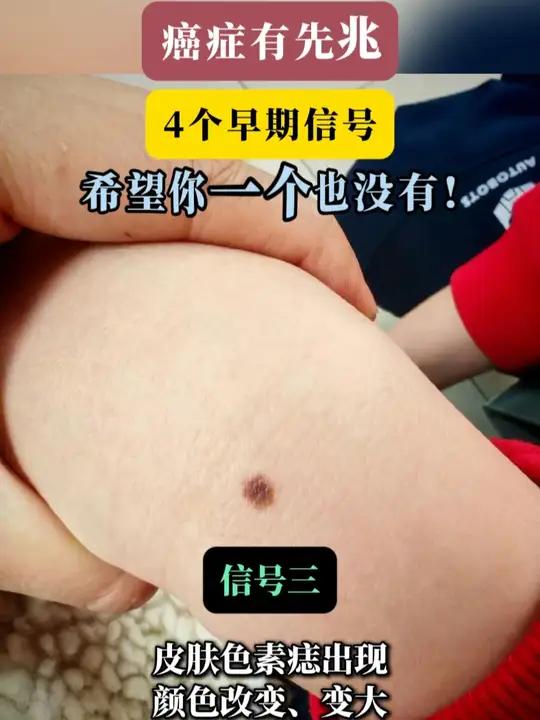癌症有先兆 4个早期信号#癌症 #健康 #健康科普不基础 #我的年度健康盘点 #抖出健康知