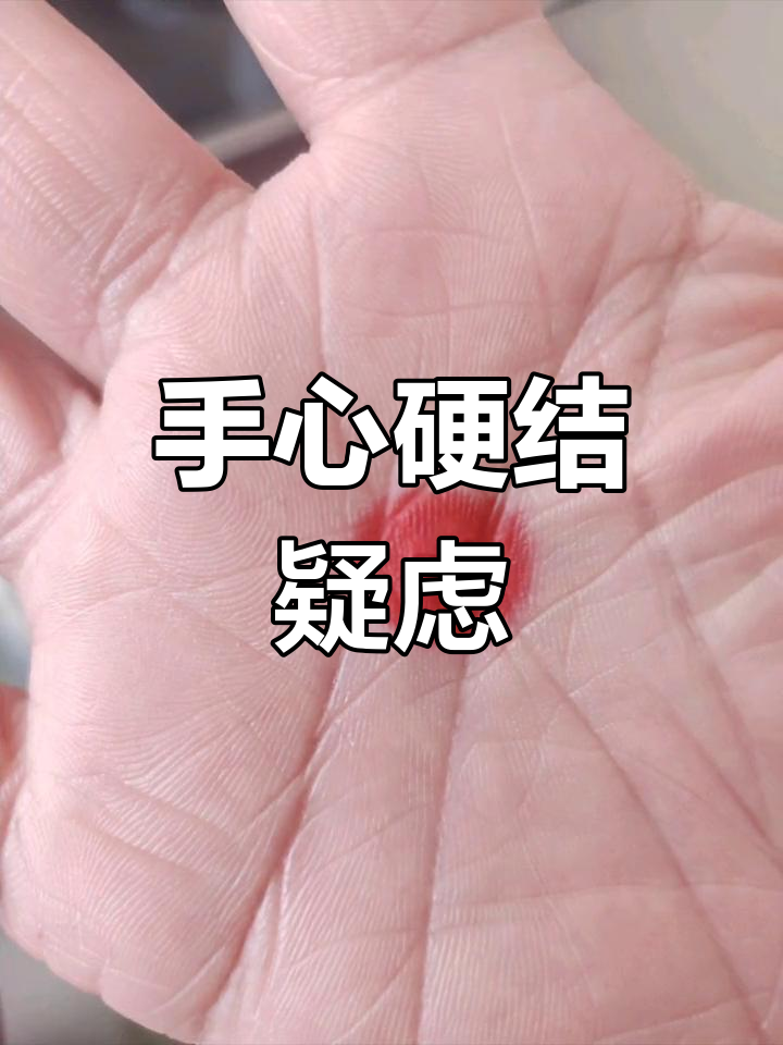 贴了鸡眼膏,手心硬疙瘩没消失,感觉不像鸡眼