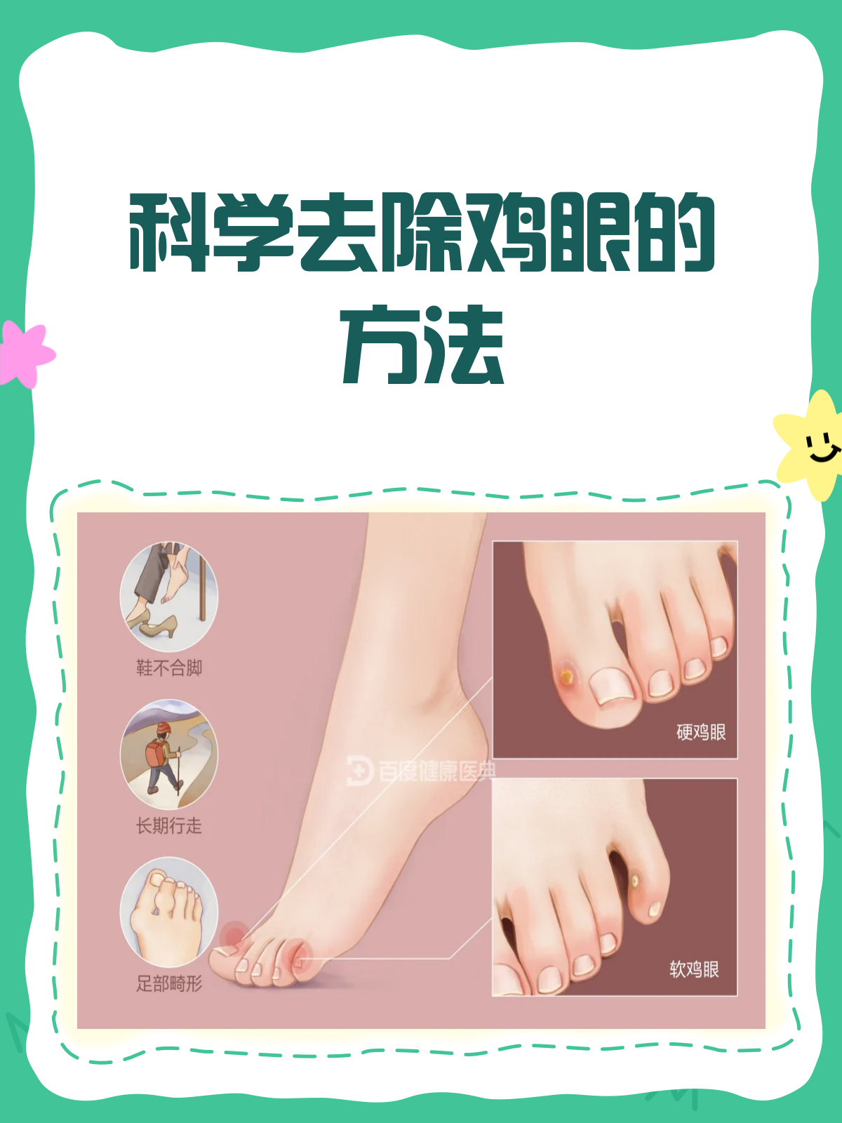 鸡眼去除小窍门?科学方法更重要!