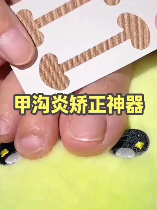 找到了指甲扎肉的纠正办法,推荐给大家,我的指甲已经纠正好了 指甲扎肉嵌甲嵌甲怎么抠出来正甲