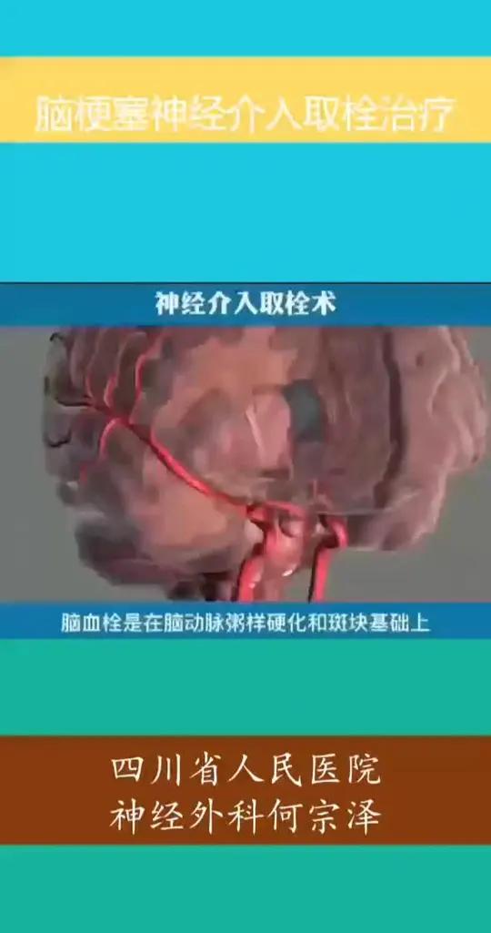 脑梗死是一种血液供应受阻导致局部脑组织缺血性坏死或软化的脑血管疾病。发病原因主要与颈部大动