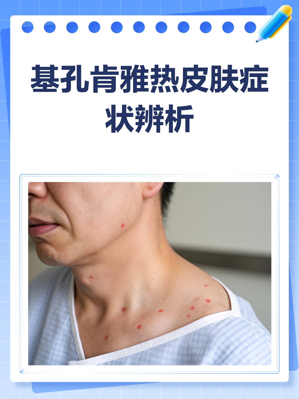 基孔肯雅热知多少?瘀点与斑丘疹的区别在这里!